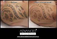 Advanced Tattoo Removal image 2